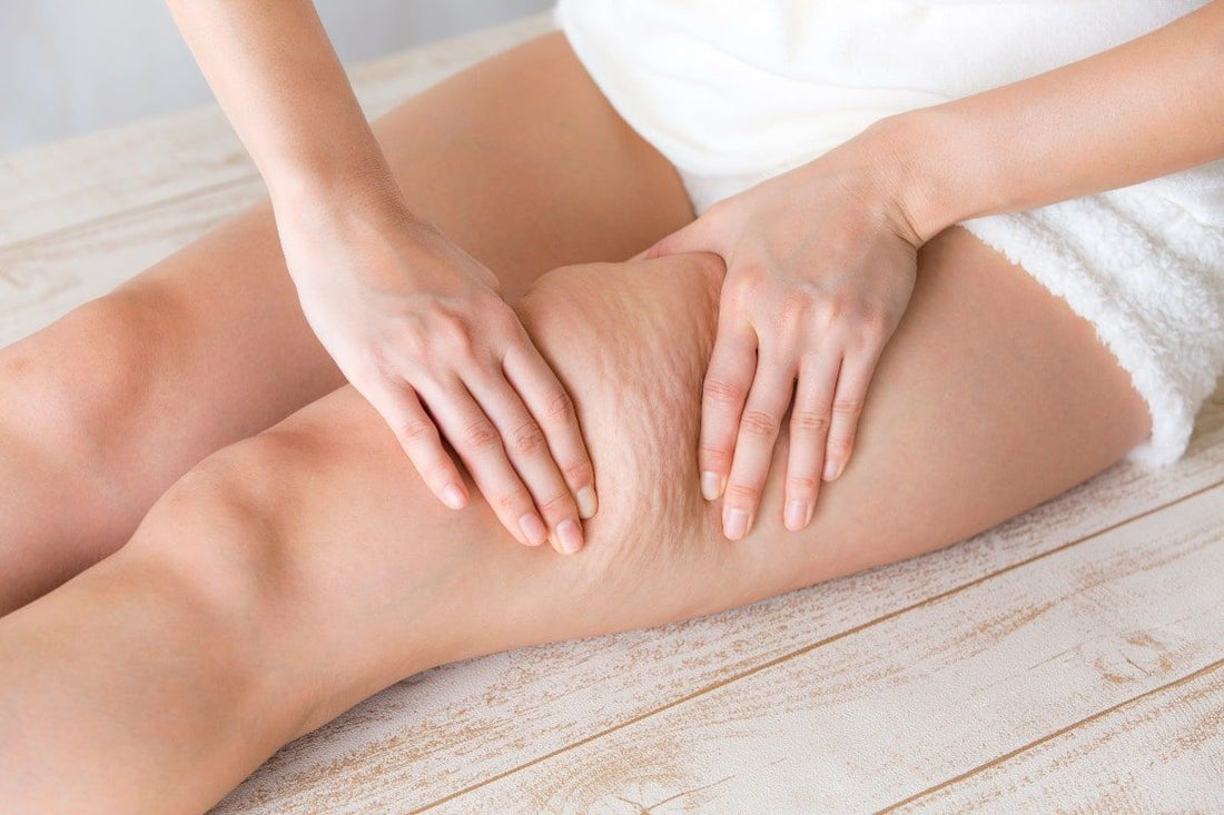 À quel âge apparaît la cellulite ? Comprendre son évolution