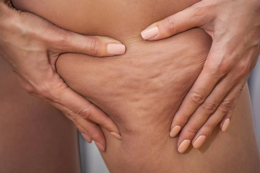 Cellulite fibreuse : comment la reconnaître et que peut-on réellement faire ?