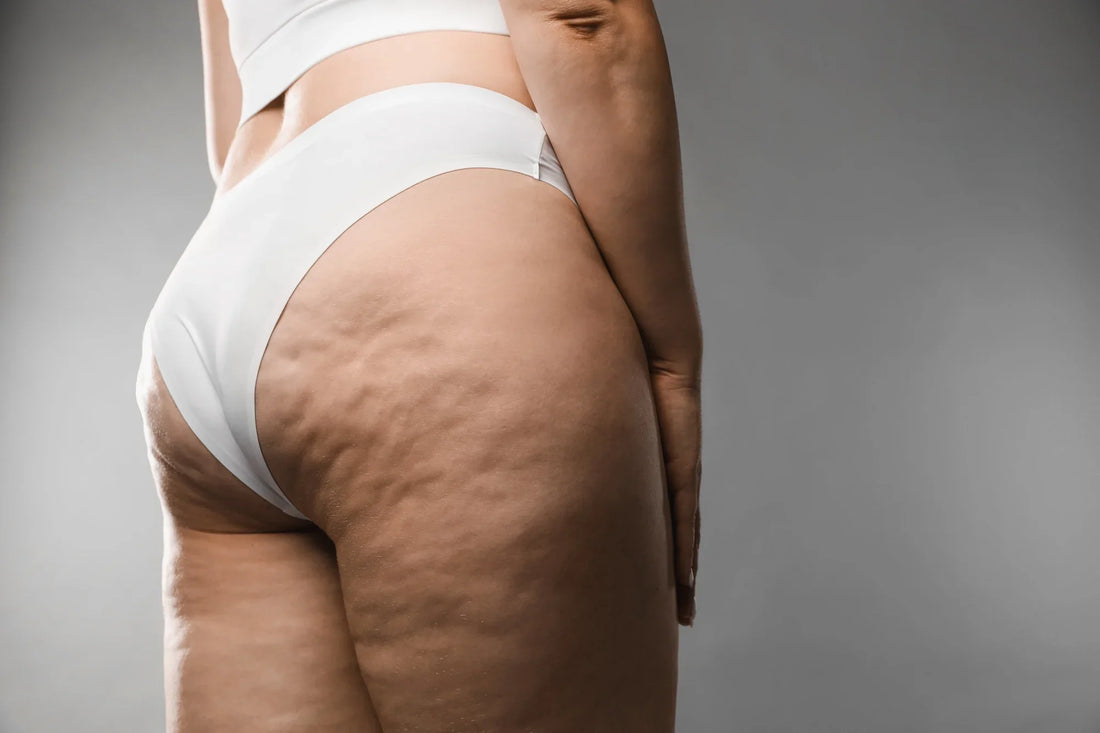 Cellulite aqueuse : qu'est-ce que c'est, et que peut-on réellement faire ?