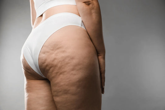 Cellulite aqueuse : qu'est-ce que c'est, et que peut-on réellement faire ?