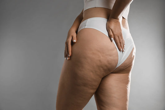 Cellulite adipeuse : comment la reconnaître et que peut-on réellement faire ?
